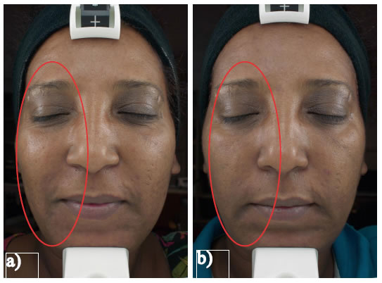 Fig. 3: standardized fotography at a) baseline and b) after a six week treatment with Jetpeel