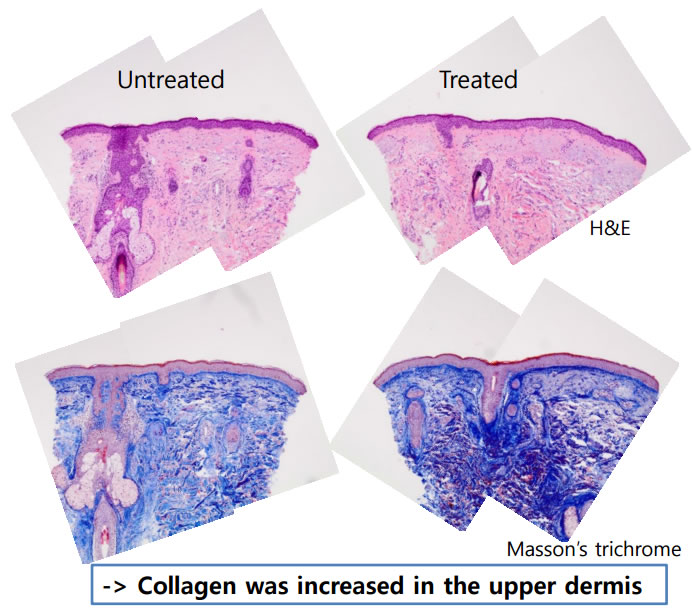 Histology Results Following JetPeel Treatment
