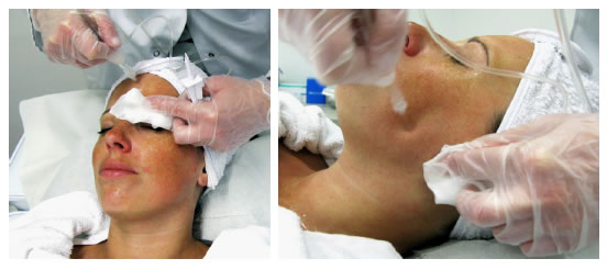Fig. 2: Treatment with Jetpeel